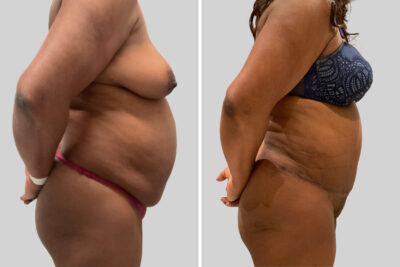 Plus Size Tummy Tuck Before and After