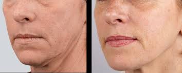 RedensityI neck